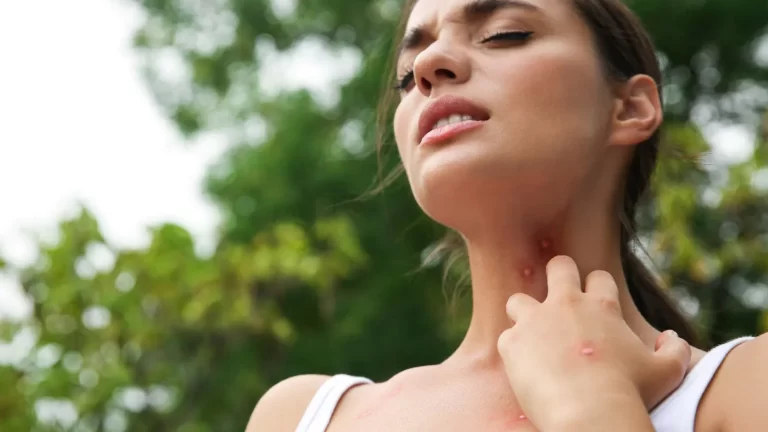 Skeeter syndrome: What to do if you get a mosquito bite allergy?