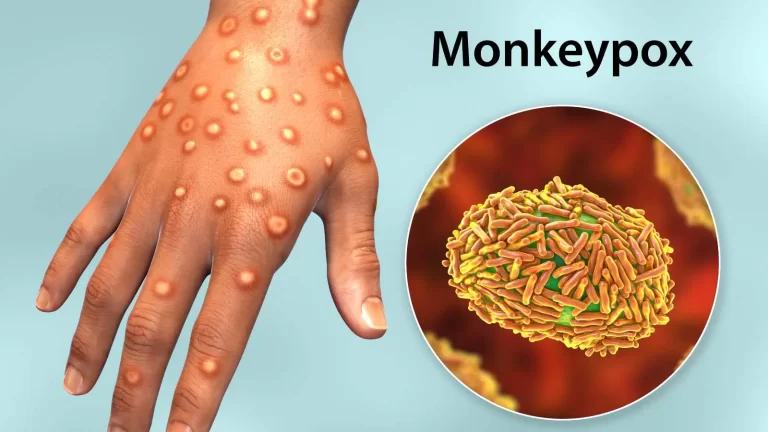 Monkeypox hits India: Know the signs and guidelines to prevent its spread