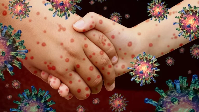 Monkeypox, dengue and more: Disease outbreaks rise in India