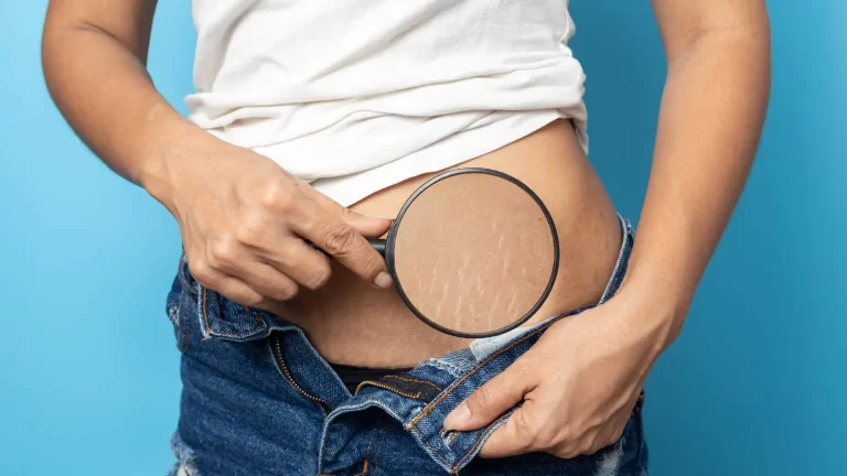 7 natural and easy ways to reduce stretch marks 