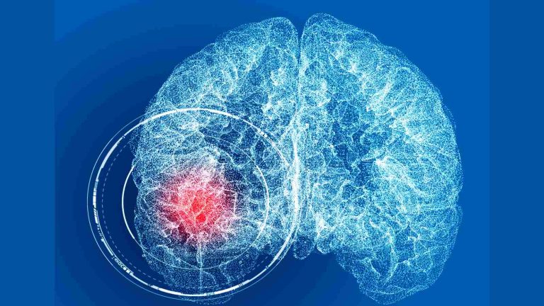 Brain aneurysm: 5 things to know about this health issue
