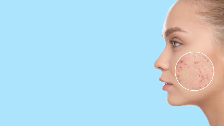 4 foolproof ways to prevent acne on one side of your face