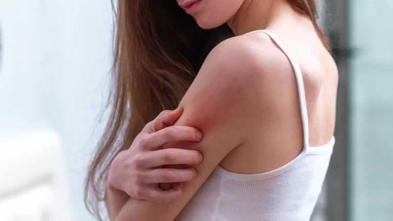 5 monsoon skin infections which may look like eczema but aren’t
