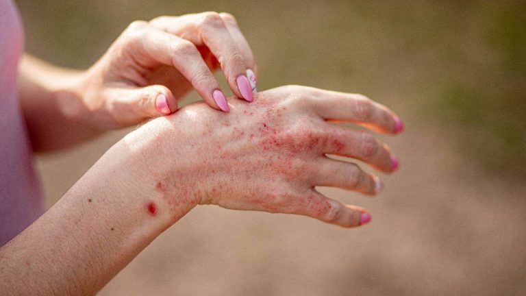 Atopic dermatitis: 5 myths busted by a dermatologist
