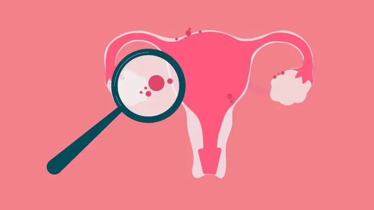 Know why endometriosis stays undiagnosed for years