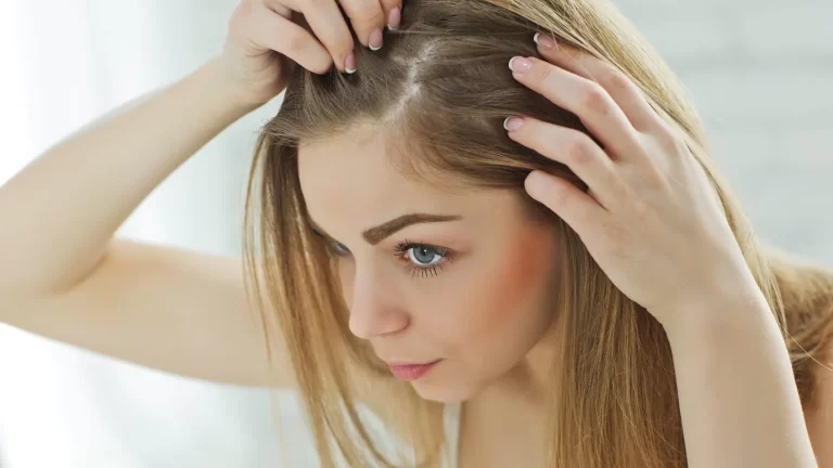 Dandruff? Try these 3 neem hair mask to treat dry scalp