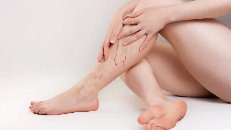 Varicose veins: Know the risk factors behind twisted, enlarged veins