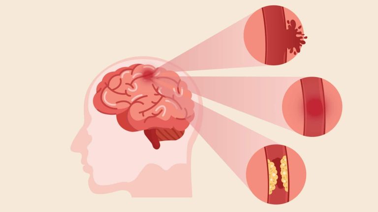 World Stroke Day: Know symptoms, risk factors and treatment of strokes