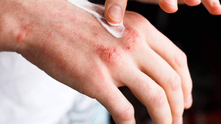 Psoriasis and mental health: Know how this skin disease is linked to stress