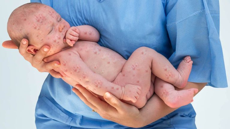 Measles outbreak: Know how to protect your child from this disease