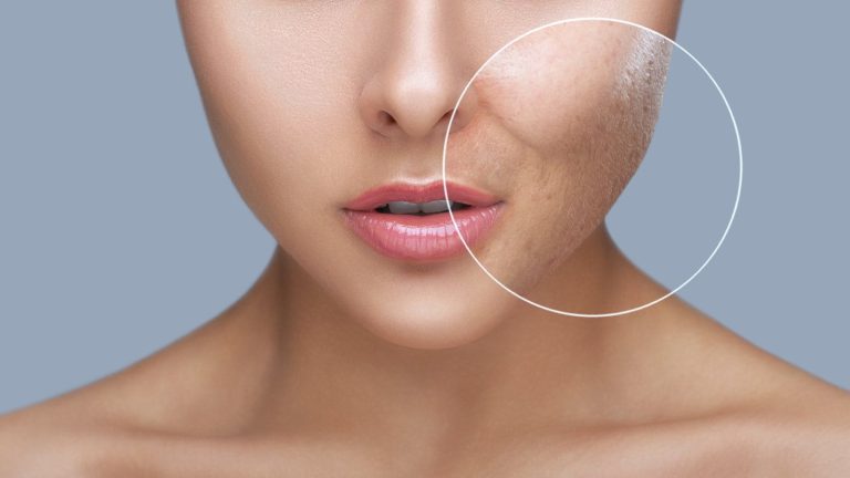 Reduce pore size for acne free skin with these 5 tips