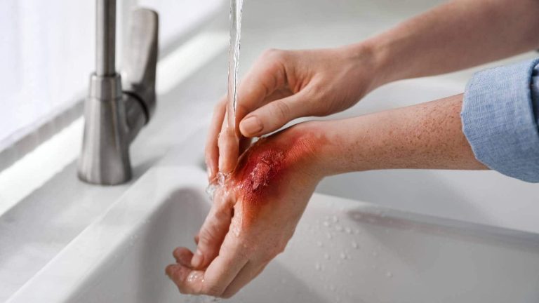 First aid for skin: How to treat cuts, burns and fungal infections