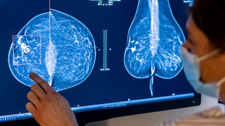 Breast cancer screenings should start at age 40, U.S. panel says