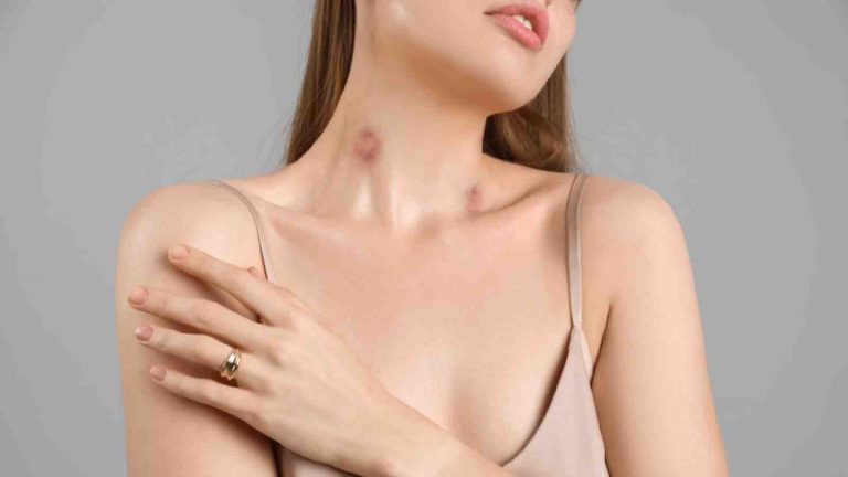 Home remedies for hickeys: Know what works and what doesn’t?